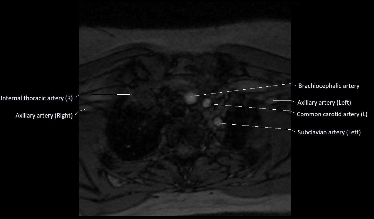 Carotid artery anatomy axial 3T image 74.jpg